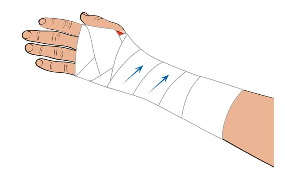 Strapping du poignet - Remise en forme - Altivie