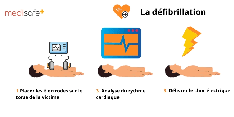 défibrillation cardiaque tuto