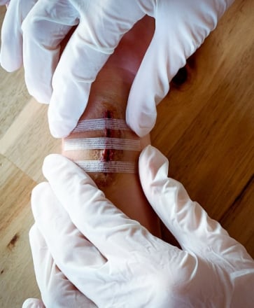 Leukosan Strip sutures cutanées adhésives BSN Médical - suturation des  plaies superficielles